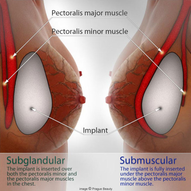 breast implants ottawa info-graphic of breast augmenation